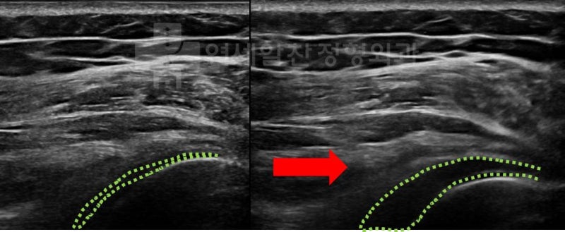 관절수액팽창술(Hydro-dilatation) 을 한 초음파 영상이다. 좌측에서의 연두색으로 표시된 관절낭이 시술 후 부풀어진 모습이 관찰된다.