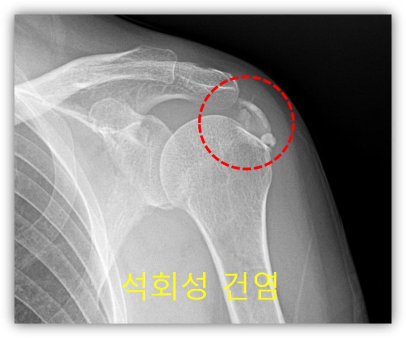 빨간 점선안에 하얗게 보이는 것이 석회이며 크기가 상당히 큰 석회가 관찰됩니다.