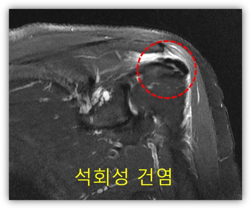 빨간 원 안에 검게 보이는 것이 석회이며 그 주위로 하얀 것들은 염증이 생기면서 발생된 염증성 물이 관찰됩니다.