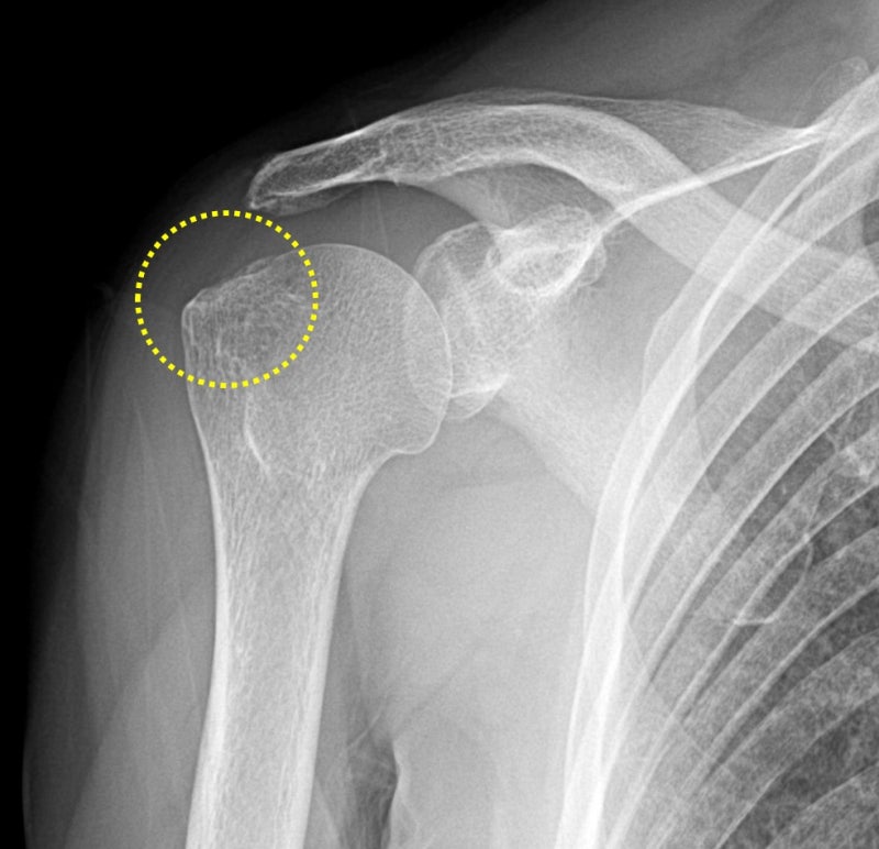 노란 점선안에 상완골의 대결절이 보이는데 이 부위가 회전근개가 부착되는 부위 입니다. 그런데 부착부의 뼈의 모양이 울퉁불퉁 한 것이 보입니다. 즉 회전근개 손상이 되었을 가능성이 아주 많은 X-ray 소견을 보입니다.