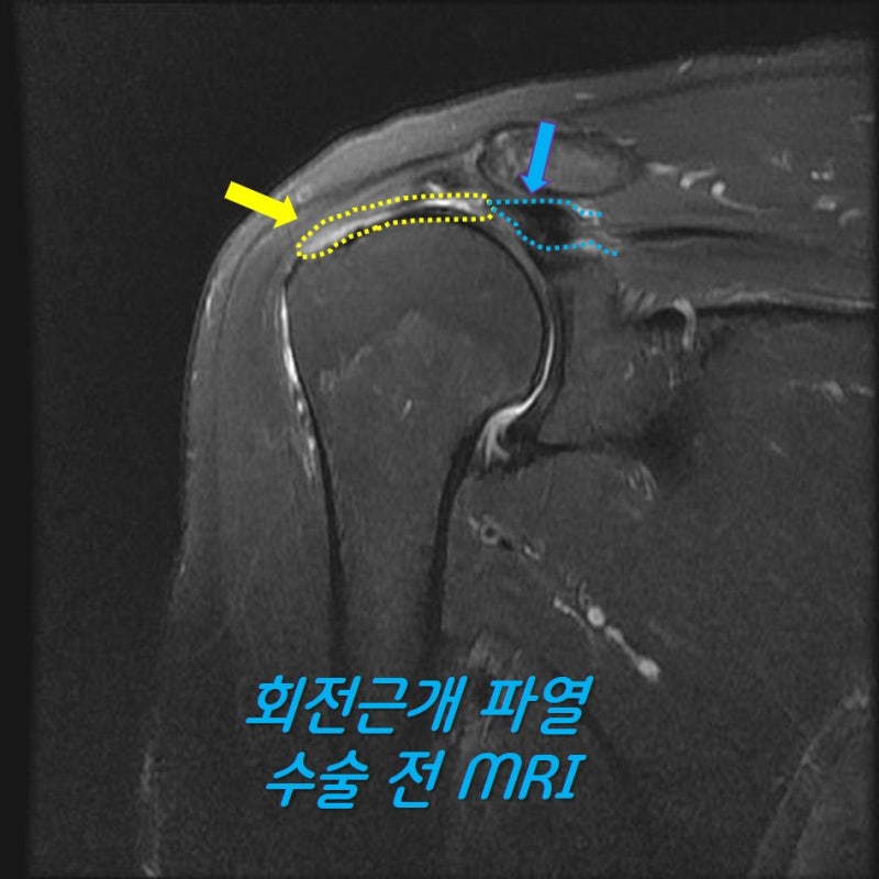 회전근개가 완전히 파열되어 원래 노란 점선안에 있어야 할 회전근개가 위축이 되어 파란점선까지 단축되어 있는 소견이 보입니다.