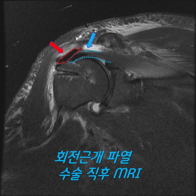파란 점선으로 표시된 것이 원래 회전근개가 봉합된 모습이며 빨간 점선으로 표시된 부위가 인조인대(allomend) 입니다.
