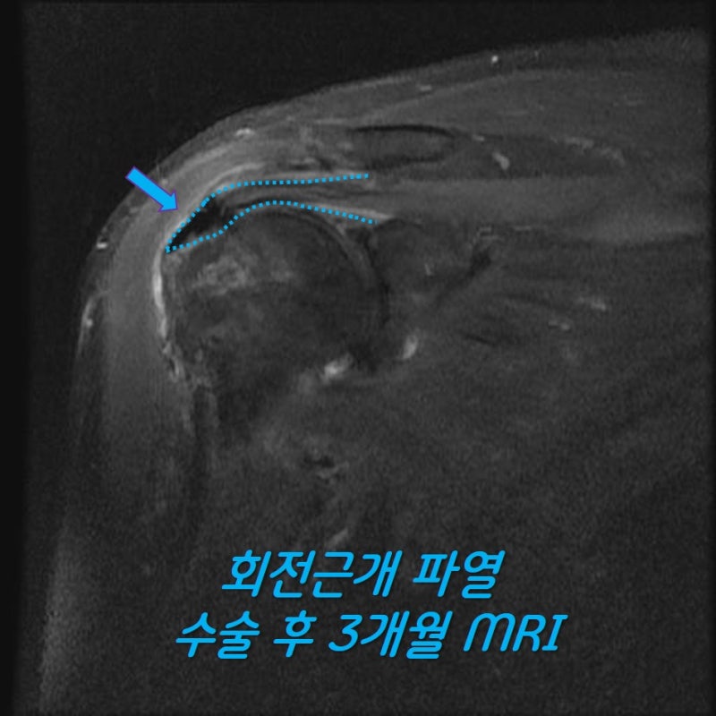 수술 후 3개월차에 촬영한 MRI 영상입니다. 인조인대가 완전히 회전근개에 생착을 하여 회전근개가 완전히 해부학적으로 보원된 것을 확인할 수 있습니다.