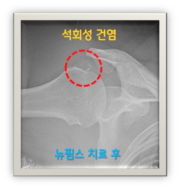 뉴핌스 치료(석회분쇄흡입술) 후 석회가 거의 사라진 것이 관찰됩니다.