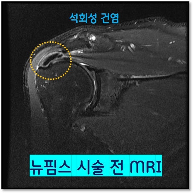 MRI 상 극상근 내부에  약 2cm 크기의 석회가 관찰되며 다른 부위의 질환이나 손상을 없는 것으로 보입니다.
