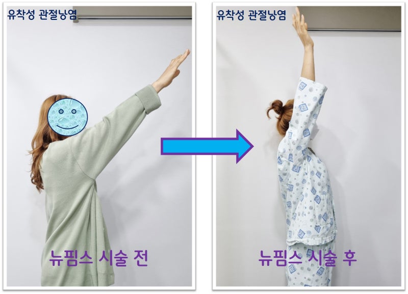 좌측 상완이 관절 가동범위 제한이 있던 것이 시술 다음날 거의 정상에 가깝게 확인된 것이 확인 됩니다.