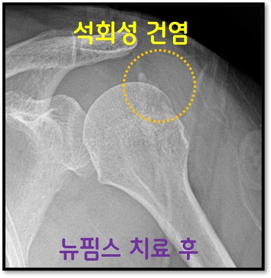 뉴핌스 치료 (석회분쇄흡입술) 시행하기 전 엄청난 크기의 석회가 거의 다 없어진 것이 확인됩니다.