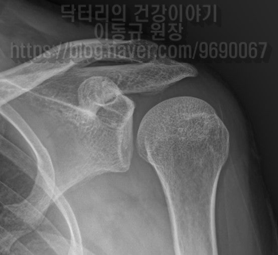 X-ray 소견은 특이소견이 없습니다.
