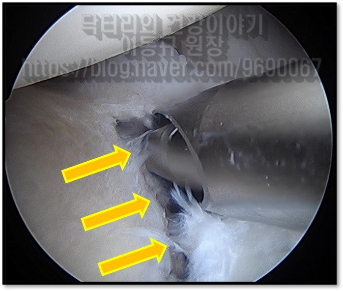 관절와순을 견갑와에 부착하기 위해 약간의 뼈를 갈아내는 사진입니다. 이 작없을 통해 약간의 출혈이 발생되고 이를 통해 파열된 조직이 생착이 이루어지게 됩니다.