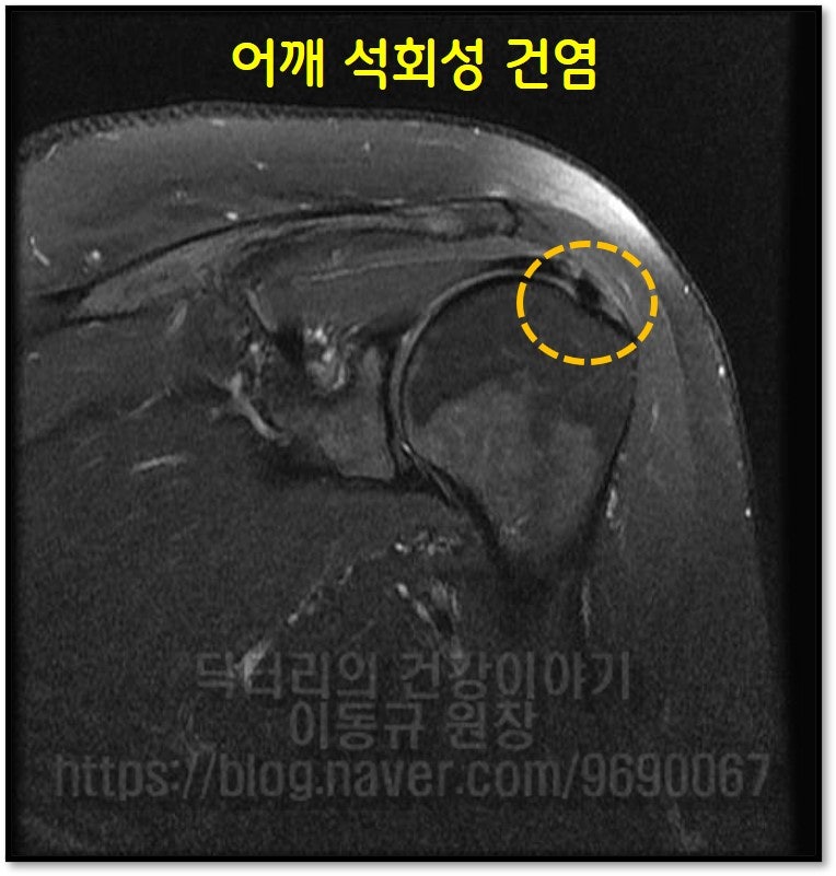MRI 영상에서도 노란 원안에 까맣게 보이는 석회가 관찰되며 다른 특이소견은 없었습니다.