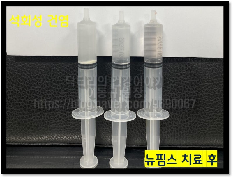 주사기에 보이는 하얀 것이 뉴핌스치료 (석회분쇄흡입술)을 통해 제거된 석회입니다.