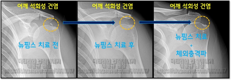 최초 사진과 비교하여 점점더 석회가 흡수가 진행되었고 충격파 시술 이후 거의 석회가 없어진 것이 확인됩니다.
