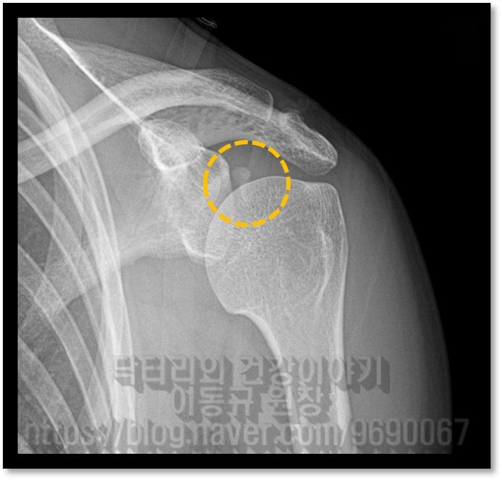 x-ray 를 보면 주황색 원 안에 하얗게 보이는 석회가 관찰됩니다. 위치는 후방 관절와에 있는 것으로 보입니다.