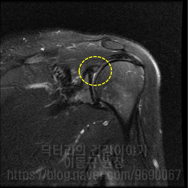 MRI 사진에서 보면 노란 원 안에 상부관절와순 파열(슬랩, SLAP) 소견이 관찰됩니다.