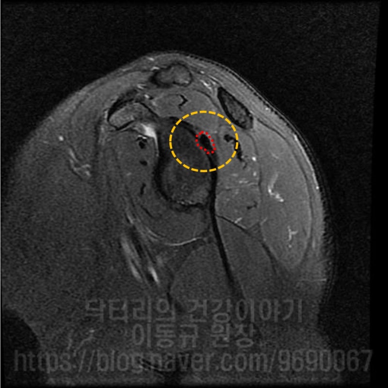 MRI 소견상 후상방 관절와순 과 관절와 사이에 빨간 점선으로 표시된 부위에 석회가 관찰됩니다.
