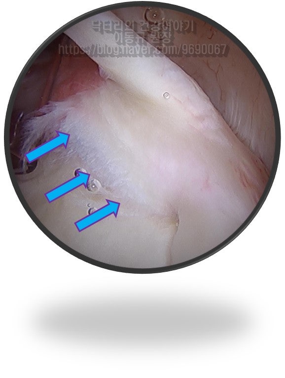화살표로 표시된 부위가 상부관절와순이 파열된 모습입니다.