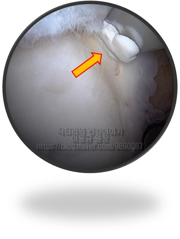 화살표로 표시된 부위가 후상방 관절와 와 관절와순 사이에 석회가 관절됩니다. 관절경 기구를 이용하여 정확한 위치를 확인하는 모습입니다.