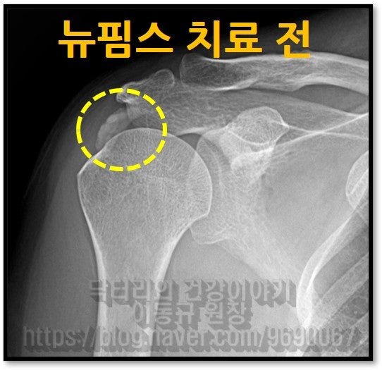 노란색 원안에 하얗게 있는 것이 석회이며 극상근에 있으며 어마어마한 크기를 보입니다.