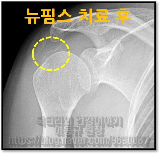 시술전에 보였던 석회가 거의 사라지고 약간 남아있는 것이 관찰됩니다.