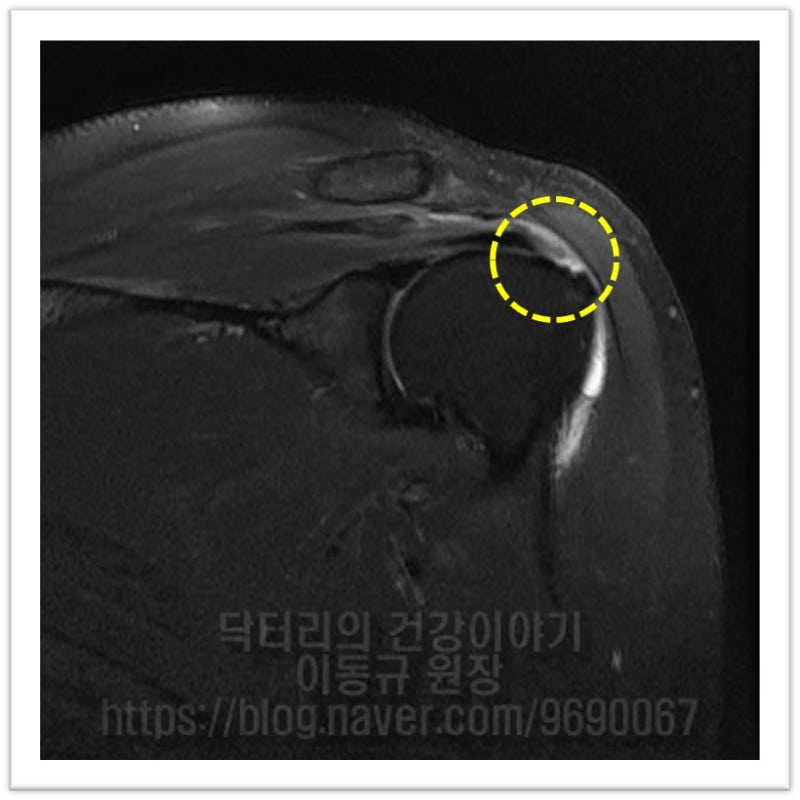 노란 원안에 극상근이 파열된 것이 보입니다. MRI 에서는 힘줄은 검게 보여야 하는데 약간 힘줄의 신호가 하얗게 보이는 것을 볼 수 있습니다.
