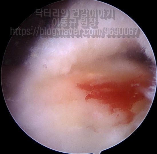 힘줄을 봉합하기 위해 상완골 대결절에 미세 출혈을 만들어 조직의 치유를 더 잘 되게 합니다.