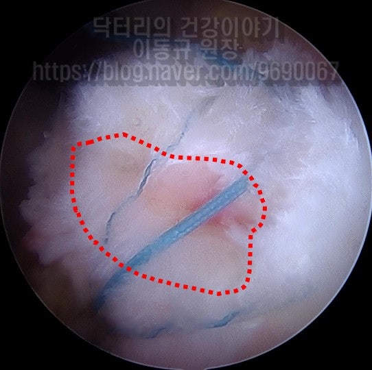 일차적으로 이열봉합법을 이용하여 봉합을 하였는데 힘줄의 상태가 너무 좋지 않고 빨간 점선 만큼의 결손 부위가 회복되지 않았습니다. 그래서 인조인대를 이용하여 보강술을 추가적으로 결정하였습니다.