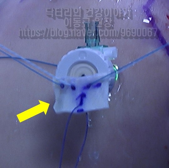 결손부위 크기를 측정하여 인조인대를 준비합니다.