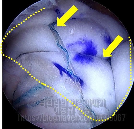 결손부위에 인조인대를 이열봉합법을 히용하여 단단히 봉합을 한 사진입니다.