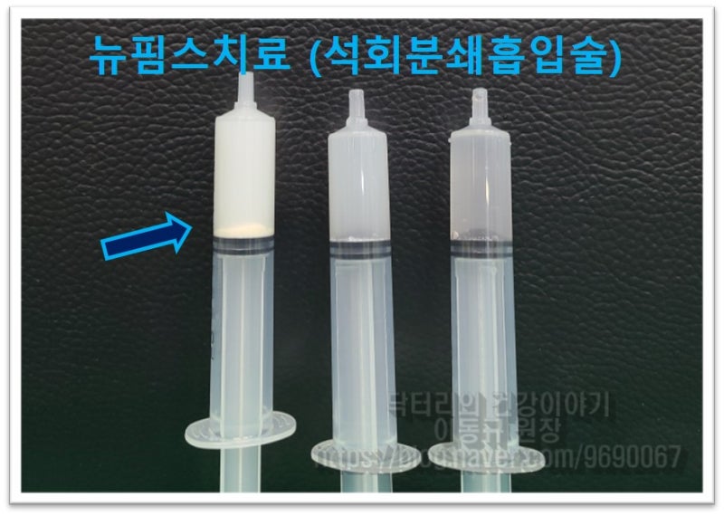 좌측 주사기를 보면 아래로 하얗게 보이는 것이 분쇄되어 나온 석회 입니다. 처음 주사기에서 거의 다 빠져 나와서 나머지 주사기에는 석회의 양이 거의 없는 것이 관찰됩니다.