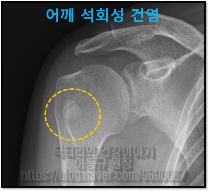 정면 X-ray 를 보면 언뜻 석회를 볼 수 없지만 노란 원 안에 자세히 보면 하얗고 동그란 뼈보다 조금더 하얀 음영을 볼 수 있습니다. 이것이 견갑하근에 발생된 석회성 건염 입니다.