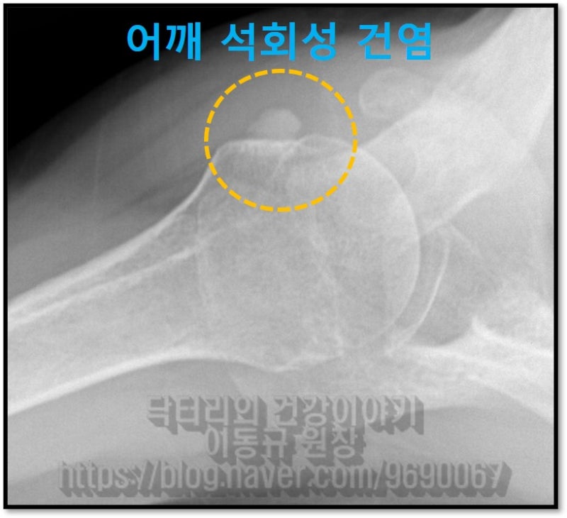 그래서 다른 각도로 촬영한 X-ray 에서는 노란 원 안에 하얗게 보이는 석회성 건염이 관찰됩니다.