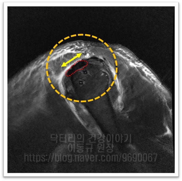 수술전 하얗게 비어있던 곳이 회전근개 봉합을 한 후 정확한 위치에 잘 부착되어 있는 것이 관찰됩니다.