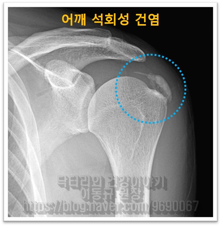 파란 원안에 하얗게 보이는 것이 석회이고 크기가 상당히 큰 것이 관찰됩니다.