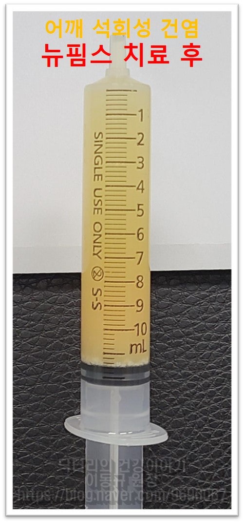 사진을 보면 주사기 안에 노란 액체가 보이는데 염증이 너무너무 심해서 염증성 물이 심하게 고여있었고 제거를 한 것입니다. 그리고 주사기 아래쪽으로 하얗게 보이는 것이 석회분쇄흡입술을 통해 제거된 석회입니다.