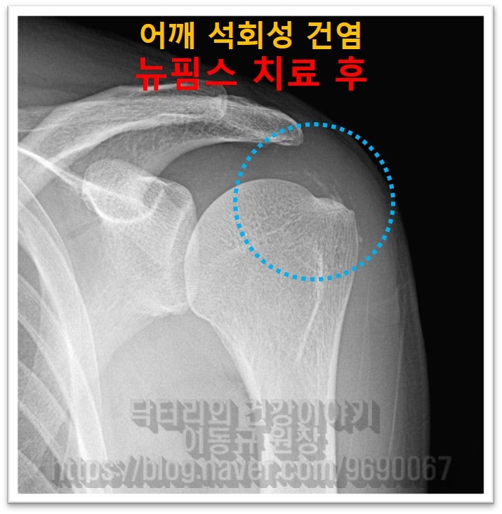 시술 후 사진을 보면 석회가 거의 제거가 되었고 약간 남아있는 것이 관찰됩니다.
