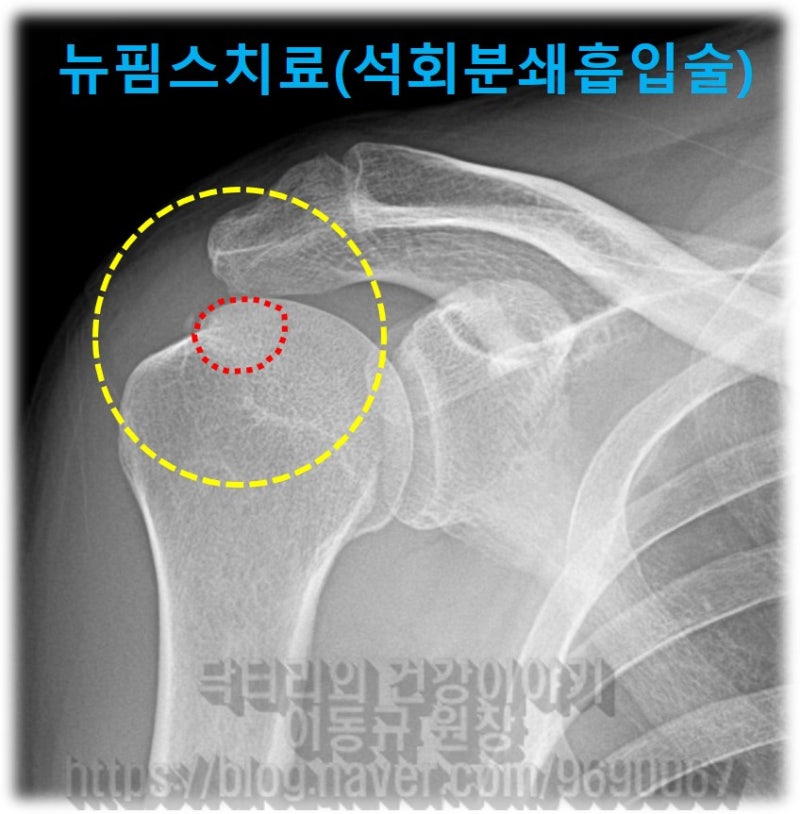견갑하근에 석회가 있어X-ray 에서 상완골과 겹처 잘 보이지는 않으나 빨간 점선으로 표시된 부위가 석회가 있고 크기도 상당히 큰것으로 확인됩니다.