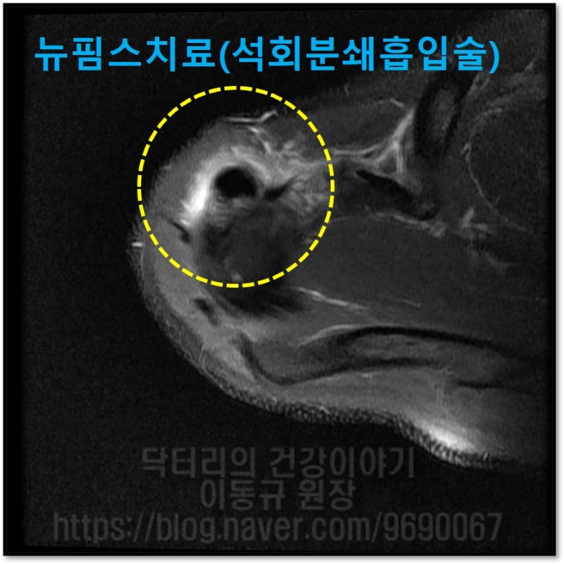 견갑하근의 상부에 노란 원안의 검은 것이 석회 입니다. 석회로 인한 염증으로 주위가 하얗게 변해있는 것이 관찰됩니다.