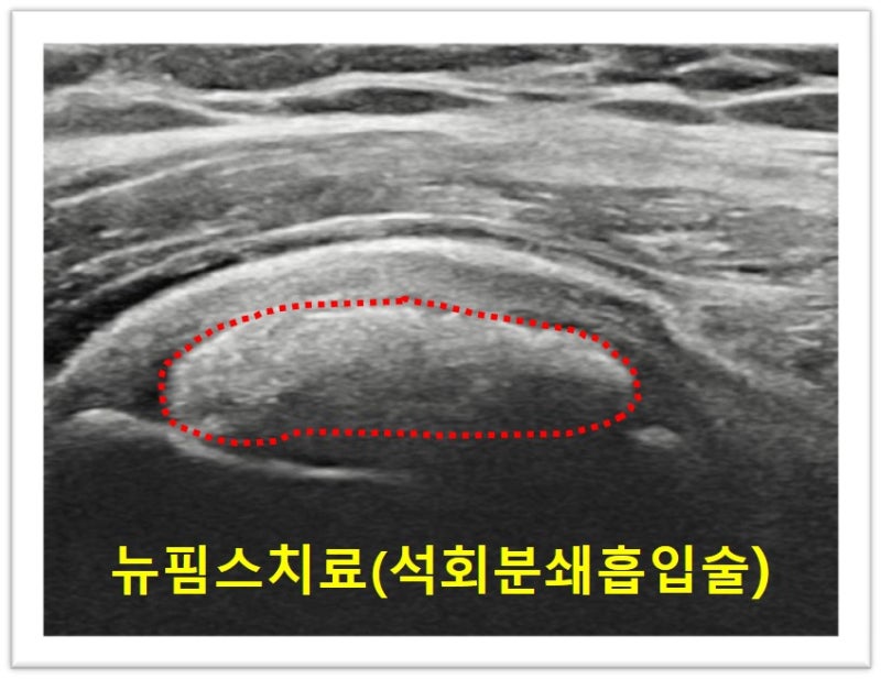 초음파 상에서도 빨간 점선으로 표시된 부위가 극상근내에 석회이며 커다란 크기로 보입니다.