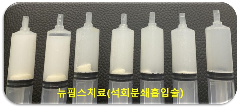 뉴핌스치료(석회분쇄흡입술)를 하고 나서 주사기를 보면 하얗게 보이는 것이 석회입니다.