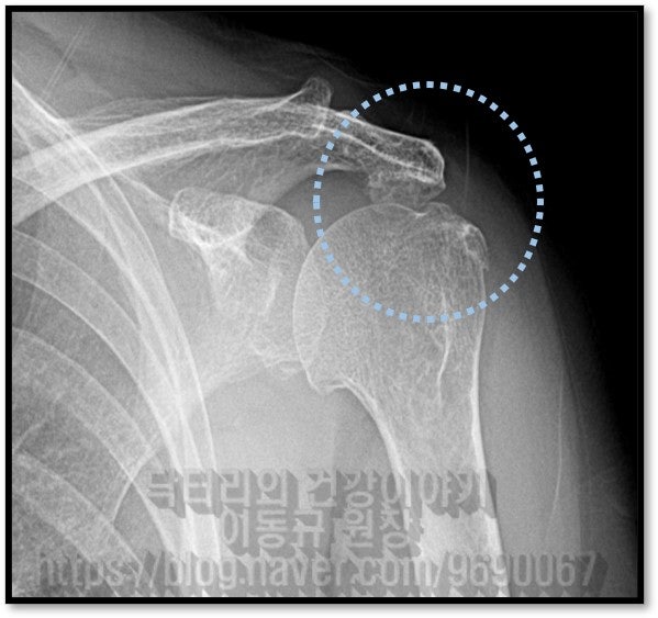 X-ray 사진을 보면 하늘색 원 안에 견봉의 뼈와 상완골 대결절의 뼈가 서로 닿아있는 것이 관찰됩니다. 즉  회전근개 손상이 오래 되었다는 소견입니다.