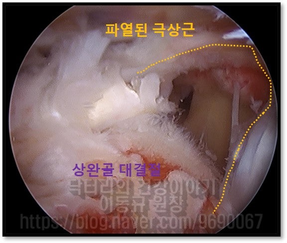 관절경 사진을 보면 노란점선으로 표시된 부위가 파열된 회전근개(극상근)이며 너덜너덜한 것이 관찰됩니다.