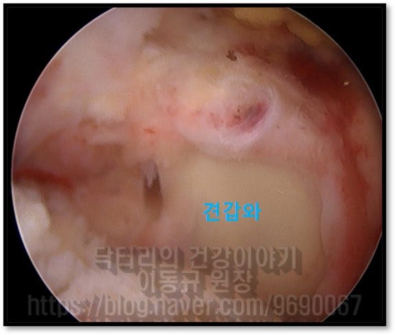 너덜거리는 기능을 하지않는 부위를 정리하고 난 사진입니다. 원래 이 view 에서는 관절이 회전근개에 덮혀있기 때문에 관절내부가 보이지 않는 것이 정상인데 완전 파열되어 위축까지 진행된 상태로 관절내부가 그대로 드러나 있는 것이 관찰됩니다.