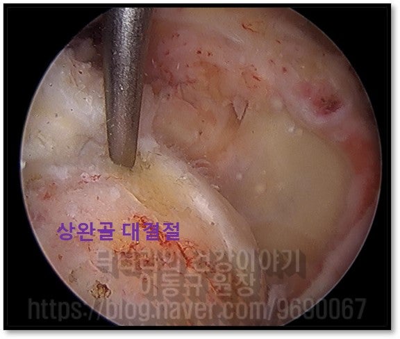 상완골 대결절에 상부관절낭 재건술을 위해  봉합나사못을 삽입합니다.