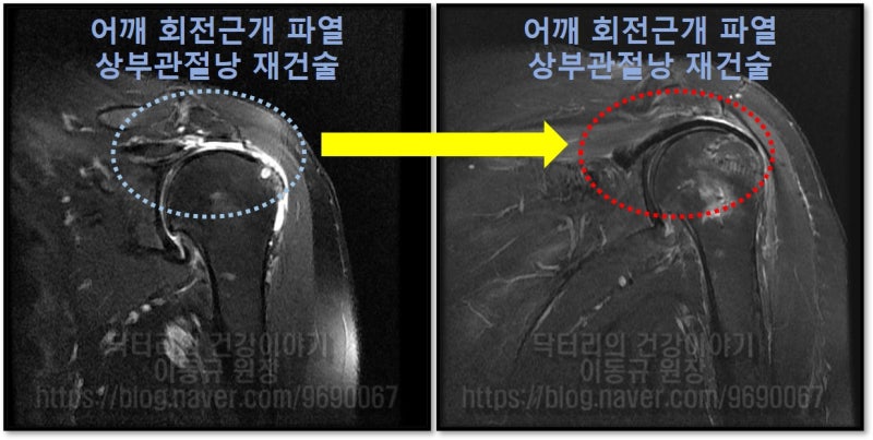 수술 전, 후 사진을 비교해 보면 복원 불가능했던 회전근개가 완벽하게 복원된 것을 알 수 있습니다.