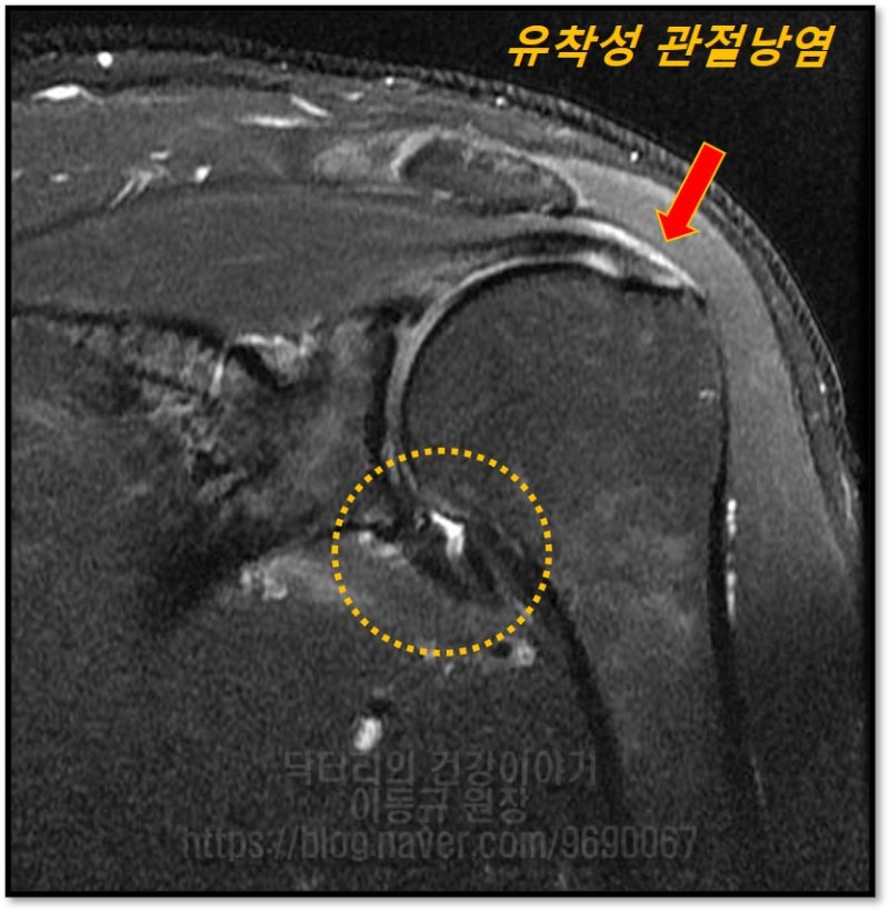 MRI 에서 주황색 원안에 관절낭이 유착되어 밴드처럼 두꺼워 진것이 관찰되며 빨간색 화살표에 보이듯 극상근의 부분적 손상과 염증 소견이 관찰됩니다.
