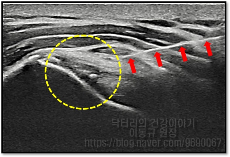 초음파를 통해 정확하게 손상된 극상근을 타겟팅하여 손상된 부위에 주사기( 빨간 화살표로 표시) 를 통해 프롤로 치료를 하는 초음파 사진 입니다.