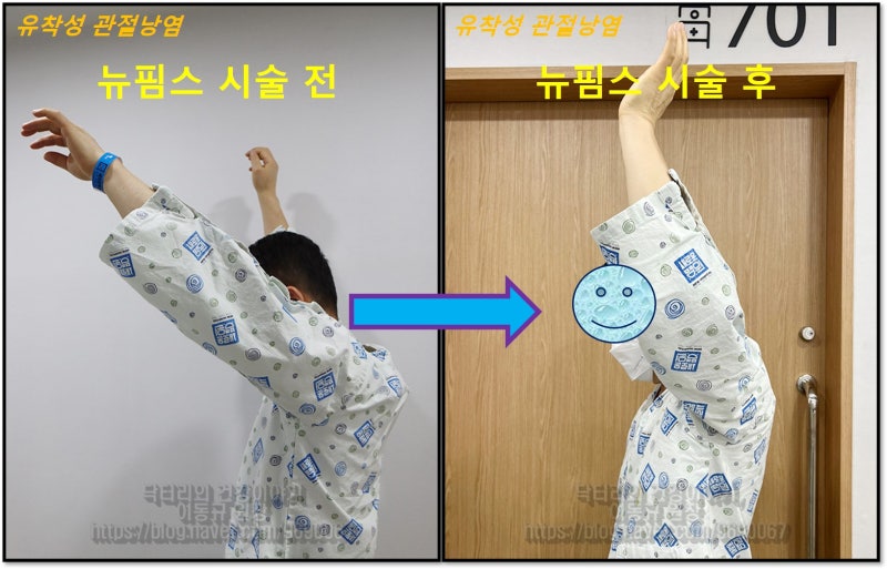 결과에서 보이듯 가동범위가 정상적으로 회복되었으며 통증도 없이 팔을 잘 움직이셨습니다.