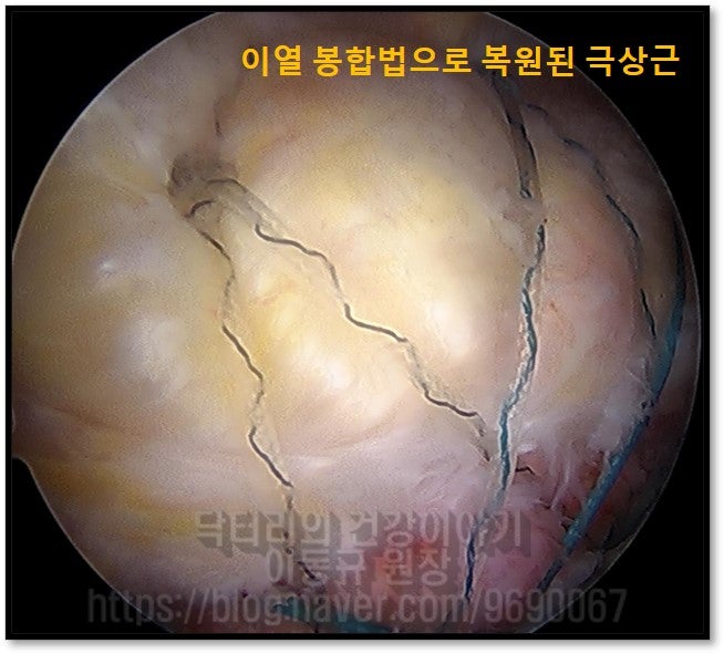 이열 봉합법으로 완변하게 복원된 모습입니다.