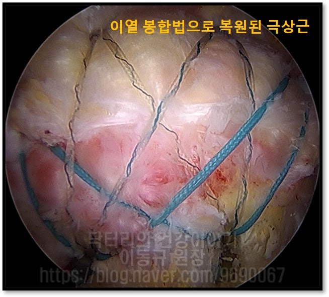 다른 각도에서 촬영한 것이며 완벽하게 복원된 모습이 관찰됩니다.