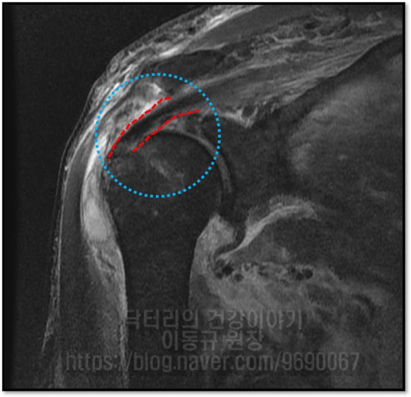 수술 후 촬영한 MRI 에서 회전근개(극상근)이 완벽하게 해부학적 위치로 복원된 것이 관찰됩니다.